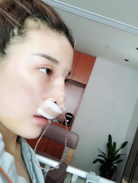 上海艺星医疗美容医院做鼻综合术后的几个小时后恢复情况