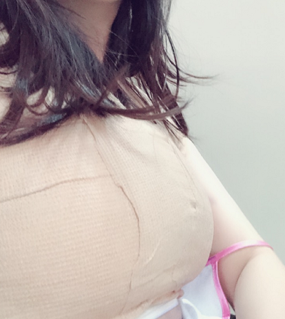 北京艺星医疗美容医院做自体脂肪隆胸手术后的胸部
