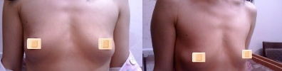 上海美莱医疗美容门诊部做假体隆胸手术前的胸