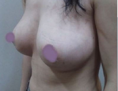 上海美莱医疗美容门诊部做假体隆胸手术后的胸部开始挺翘