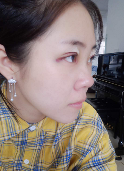 北京东方瑞丽医疗美容门诊部做双眼皮刚刚做完手术