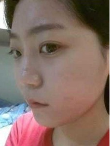 上海时光整形外科医院赵克昶做耳软骨隆鼻案例效果分享