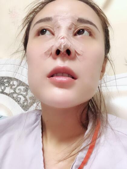 上海艺星医疗美容医院做鼻综合术后恢复还有点肿
