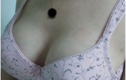 上海美莱医疗美容门诊部做假体隆胸术后无钢圈内衣