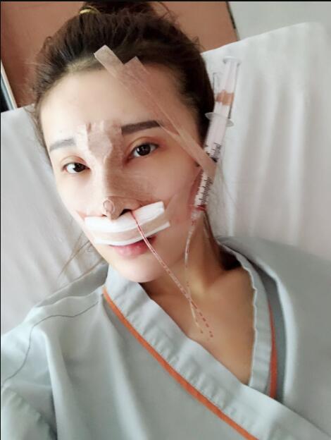 上海艺星医疗美容医院做鼻综合术后躺在床上恢复
