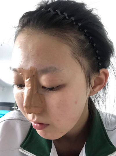 南京美贝尔医疗美容医院黄名斗做自体软骨隆鼻案例效果分享