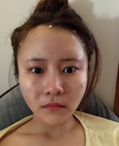 上海美莱医疗美容门诊部做面部填充手术前的状态