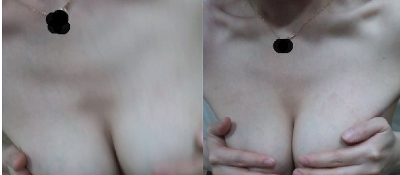 上海美莱医疗美容门诊部做假体隆胸术后的最终效果