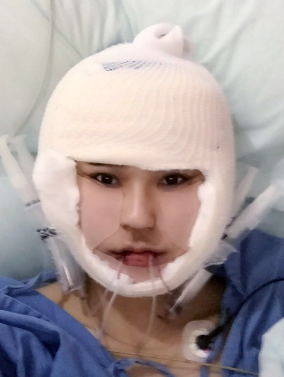北京京民医院（原钓鱼台医院）整形外科做下颌骨刚刚结束手术