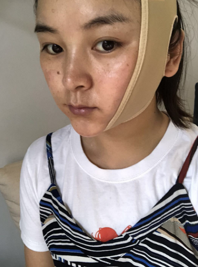 上海东方丽人美容医疗医院做面部吸脂刚刚结束手术后