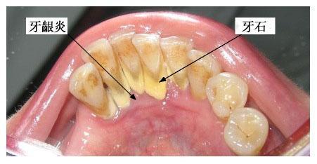  广州柏德口腔牙龈炎怎样治疗吃什么消炎药？