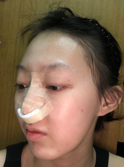 南京美贝尔医疗美容医院做自体软骨隆鼻术后要进行拆线