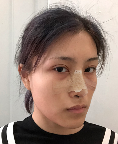 上海港华医疗美容医院做隆鼻刚刚结束手术