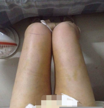  东莞华美医疗美容医院做大腿吸脂手术后的一个月