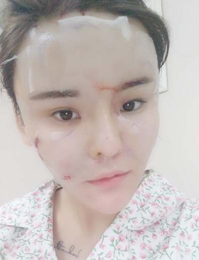 上海美莱医疗美容门诊部做面部填充刚刚结束手术