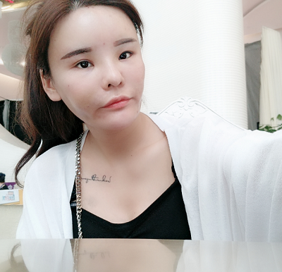 上海美莱医疗美容门诊部做面部填充手术后的日常恢复