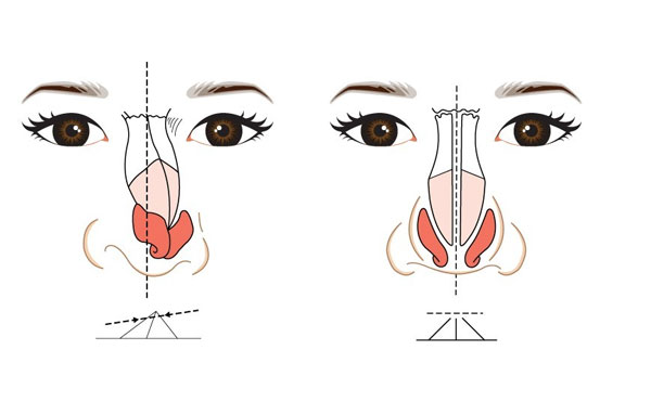 歪鼻矫正术的风险大吗?鼻梁歪怎么矫正歪鼻的矫正及补救方法?